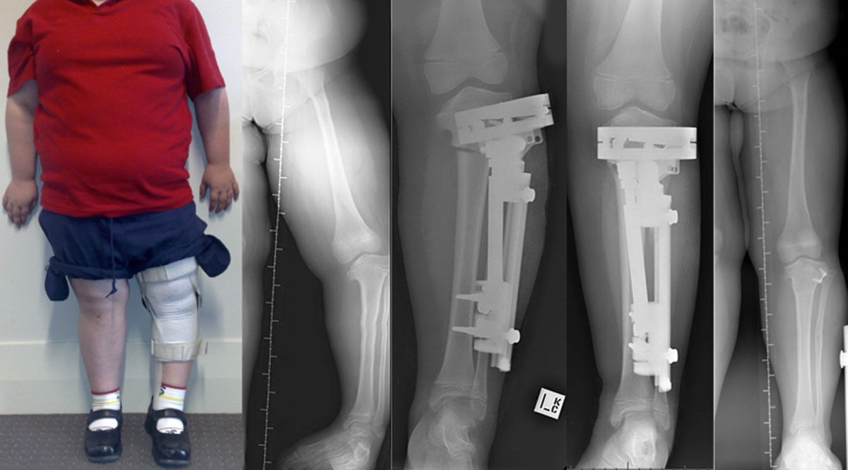 BONE DEFORMITY
