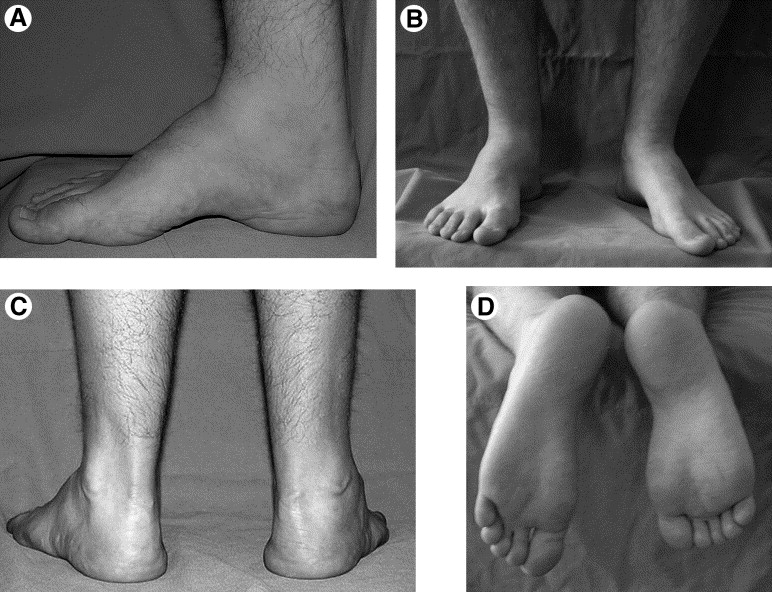 FOOT DEFORMITY