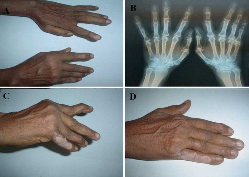 HAND DEFORMITY