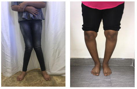 KNEE DEFORMITY