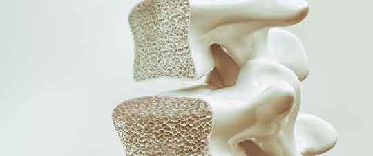 OSTEOPOROSIS