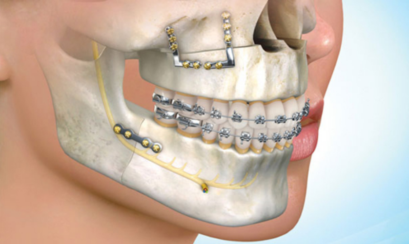 Maxilo facial surgery